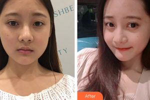 湛江華美整形美容醫(yī)院王軍整形價(jià)格表附熱瑪吉案例展示