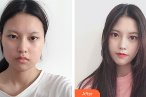 湛江中心人民醫(yī)院燒傷整形手外科黃宇倫整形價(jià)格表附下頜角整形案例展示