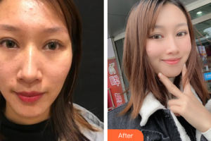 湛江澳泰整形美容醫(yī)院曾兆舜整形價(jià)格表附去痘印痘坑案例展示