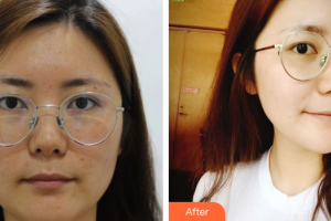 湛江華美整形美容醫(yī)院汪峰整形價(jià)格表附面部吸脂案例展示