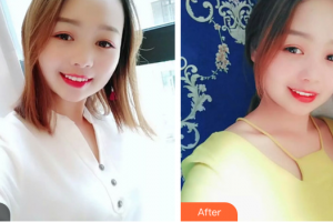 湛江南方口腔醫(yī)院黃宏整形價(jià)格表附皓齒美白案例展示