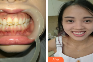 湛江南方口腔醫(yī)院黃和生整形價(jià)格表附瓷貼面案例展示