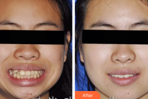 湛江南方口腔醫(yī)院袁兵整形價(jià)格表附矯正牙齒案例展示