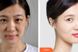 茂名市人民醫(yī)院燒傷整形科邱世國(guó)整形價(jià)格表附激光祛斑案例展示