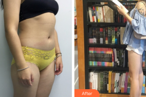 茂名華美整形美容醫(yī)院田艷軍整形價(jià)格表附大腿吸脂案例展示