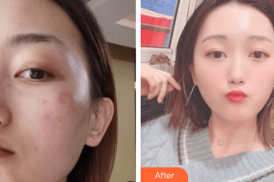 茂名華美整形美容醫(yī)院禤麗艮整形價(jià)格表附激光祛斑案例展示