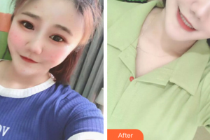 茂名華美整形美容醫(yī)院孟英堂整形價(jià)格表附果酸煥膚案例展示