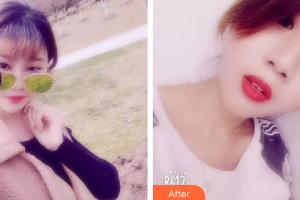 肇慶市第一人民醫(yī)院燒傷整形科周強(qiáng)整形價(jià)格表附紅藍(lán)光祛痘案例展示