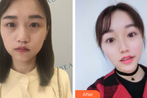 肇慶華美整形美容醫(yī)院陳巍整形價(jià)格表附熱瑪吉案例展示