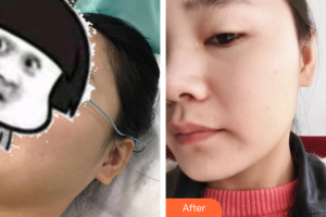 肇慶民和醫(yī)院激光整形科馮士彬整形價(jià)格表附光子嫩膚案例展示