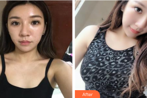 肇慶華美整形美容醫(yī)院方林均整形價(jià)格表附假體隆胸案例展示