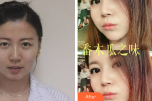 肇慶民和醫(yī)院激光整形科唐海軍整形價(jià)格表附全切雙眼皮案例展示