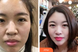 肇慶市皮膚病醫(yī)院醫(yī)療美容科莫家亮整形價(jià)格表附光子嫩膚案例展示