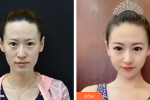 肇慶市皮膚病醫(yī)院醫(yī)療美容科聶金漢整形價格表附光子嫩膚案例展示