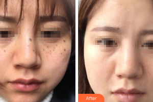 肇慶市皮膚病醫(yī)院醫(yī)療美容科譚波整形價格表附激光祛斑案例展示