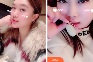 肇慶市皮膚病醫(yī)院醫(yī)療美容科羅中權(quán)整形價格表附果酸煥膚案例展示