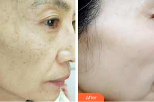 肇慶市皮膚病醫(yī)院醫(yī)療美容科余群英整形價格表附激光祛斑案例展示