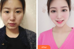 肇慶華美整形美容醫(yī)院饒焱整形價格表附熱瑪吉案例展示