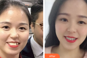 肇慶中大口腔醫(yī)院鐘育軍整形價格表附自鎖矯正案例展示