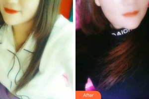 肇慶中大口腔醫(yī)院周永標(biāo)整形價格表附時代天使矯正案例展示