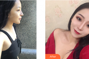 梅州市人民醫(yī)院燒傷整形科曾運泉 整形價格表附假體隆胸案例展示