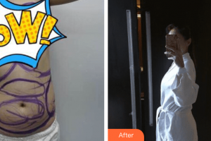 梅州方圓醫(yī)療美容門診部楊斌整形價格表附全身吸脂+脂肪豐胸案例展示