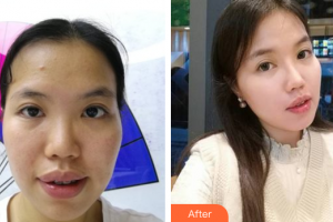 梅州諾麗醫(yī)療美容門診部杜國華整形價格表附自體脂肪全臉填充案例展示