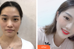 梅州曙光醫(yī)療美容醫(yī)院黃丹整形價格表附光子嫩白案例展示