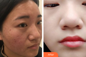 東莞中韓醫(yī)療美容診所何玲整形價格表附果酸＋點陣案例展示