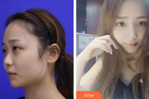 東莞華美女子醫(yī)學(xué)美容診所王曉潔整形價格表附鼻子塑造案例展示