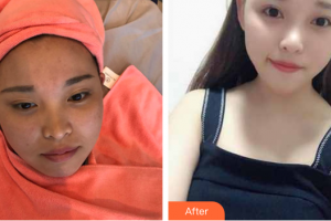 東莞康華醫(yī)院整形美容中心王春梅整形價格表附皮膚管理案例展示