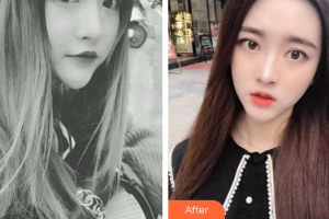 東莞康華醫(yī)院整形美容中心王德宏整形價格表附光學(xué)靚膚祛斑案例展示