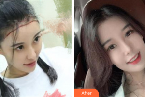 東莞東風(fēng)醫(yī)療美容中心黃杰整形價格表附種植發(fā)際線案例展示