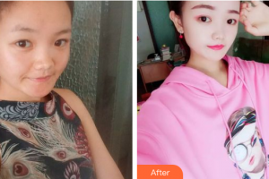 東莞東華醫(yī)院燒傷整形科蘇順清整形價格表附果酸換膚案例展示