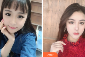 東莞知美整形醫(yī)院黃利整形價格表附膨體隆鼻案例展示