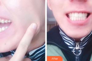 東莞知美整形醫(yī)院謝榮壽整形價格表附牙齒隱形矯正案例展示