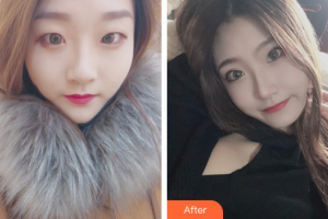 東莞知美整形醫(yī)院黃雙聞?wù)蝺r格表附雙眼皮案例展示