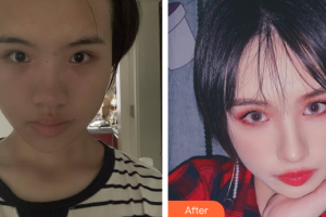 東莞美立方美容醫(yī)院林武龍整形價格表附面部埋線提升提升案例展示