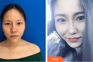 東莞百佳瑪麗亞婦產(chǎn)醫(yī)院陳蓉蓉整形價格表附微針祛痘嫩膚案例展示