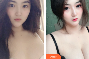 東莞百佳瑪麗亞婦產(chǎn)醫(yī)院金進整形價格表附假體隆胸案例展示