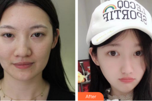 東莞韓美整形醫(yī)院金賢珠整形價格表附激光祛斑案例展示