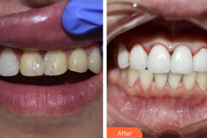 東莞康華醫(yī)院整形美容中心王篤權(quán)整形價格表附口腔美學(xué)貼面案例展示