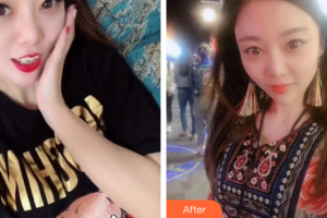 東莞康華醫(yī)院整形美容中心殷安柱整形價格表附光子嫩膚案例展示