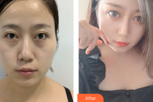 東莞主山愛康門診部醫(yī)學(xué)整形美容中心廖旭峰整形價格表附激光去眼袋案例展示