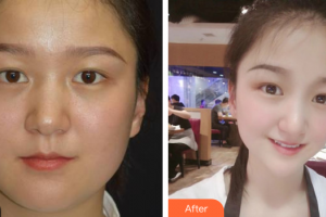 東莞韓美整形醫(yī)院廖星高整形價格表附射頻溶脂瘦臉案例展示