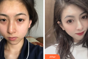 東莞締美整形美容醫(yī)院黃維林整形價格表附熱瑪吉案例展示