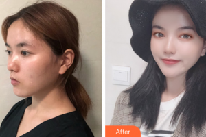 東莞締美整形美容醫(yī)院馬可·斯塔比整形價格表附埋線提升提升案例展示