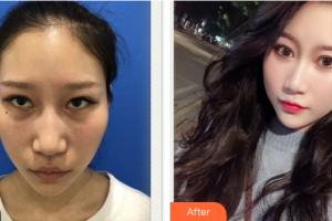 東莞瑞芙臣醫(yī)療美容門診部MichelPfulg整形價格表附激光去眼袋案例展示