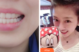 東莞美立方美容醫(yī)院曹德華整形價格表附隱形矯正案例展示