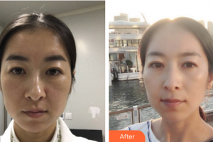 東莞瑞芙臣醫(yī)療美容門診部Christine整形價格表附熱瑪吉案例展示